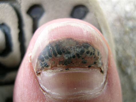 Does toenail fungus cause nails to fall off? hematology - Why do toenails turn black after impact ...