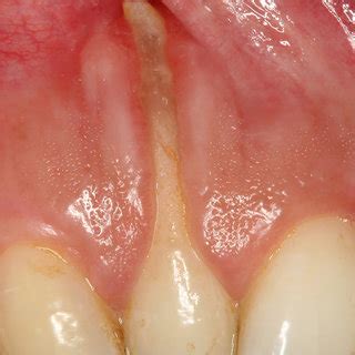 Pdf Treatment Of An Advanced Gingival Recession Involving The Apex Of