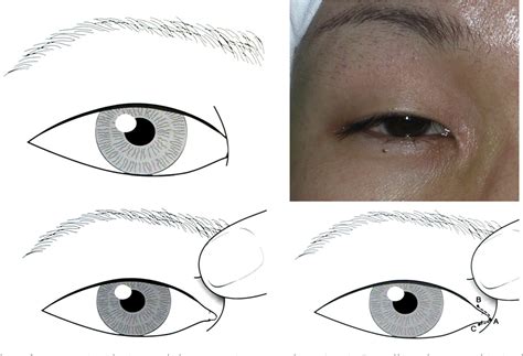 Figure 1 From Medial Epicanthoplasty Using The Palpebral Margin