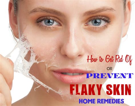 How To Get Rid Of Or Prevent Flaky Skin Home Remedies Stylish Walks