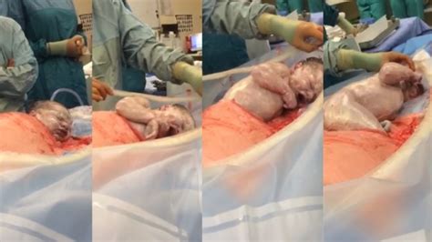 Baby coming out of virginia. Amazing footage of baby 'walking' out of womb during ...