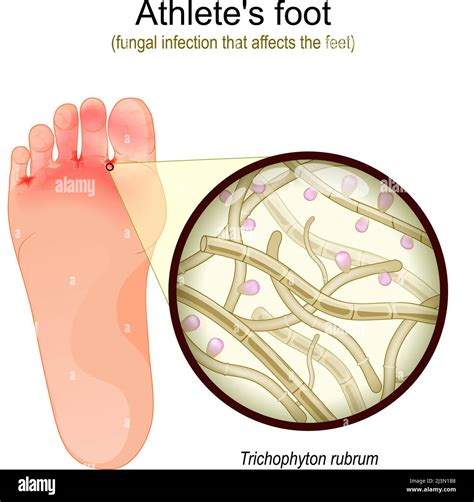 Athletes Foot Is A Fungal Infection That Affects The Feet Sole Of