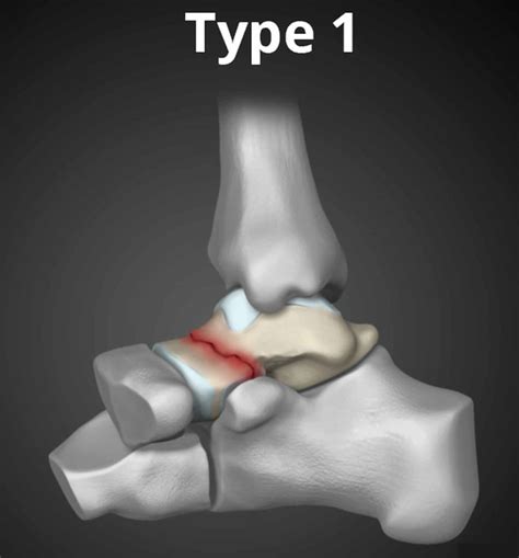 Talus Fracture Causes Types Symptoms Complications Diagnosis