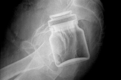 World S Worst A E Sexual Misadventure X Rays Revealed From Coffee Jars To Deodorant Cans And