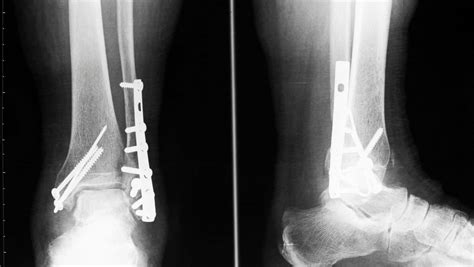 Lateral Malleolus Fracture Advice Faq On Lateral Malleolus Fractures