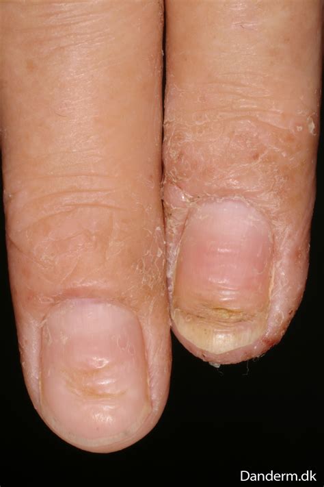 4 80 2 Eczema Nails