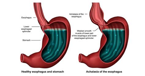 Cary Gastroenterology Associates What To Know About Esophageal