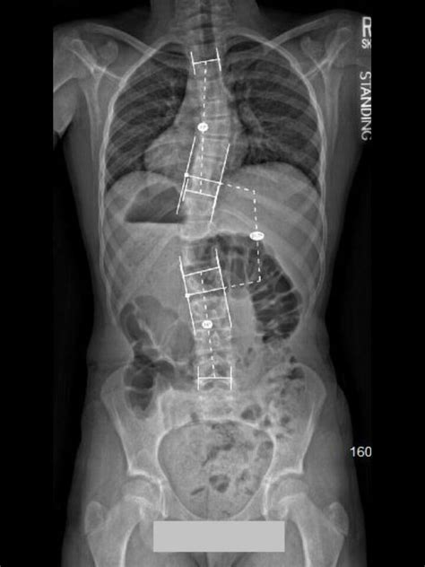 Spinal Technology Sct 3d Wilmington Style Scoliosis Brace