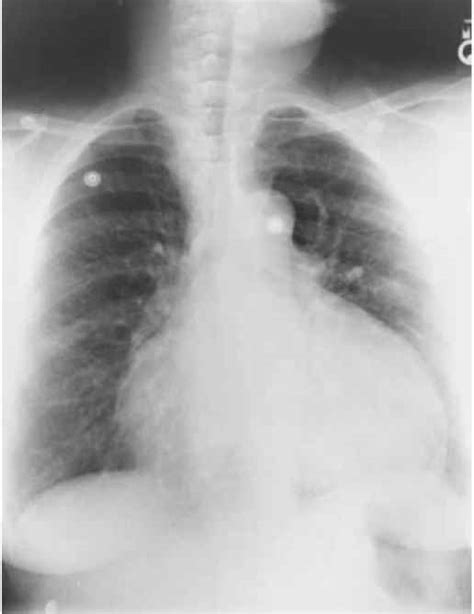 Cardiac Tamponade Chest X Ray