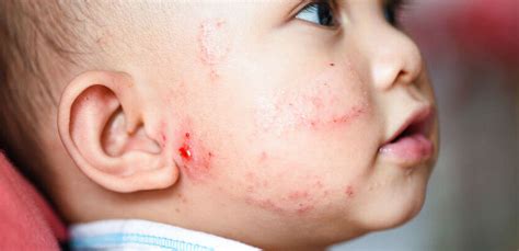 Alergia U Dzieci I Niemowl T Jak J Rozpozna