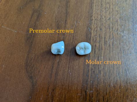 My Crown Fell Out What Should I Do Afterva Oral Health Library