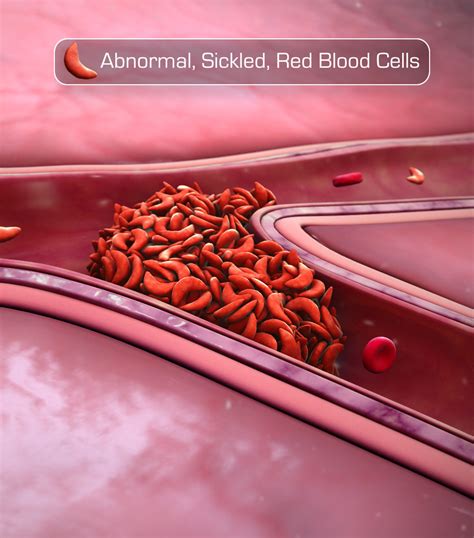 The most common type is known as sickle cell anaemia (sca). Sickle Cell Disease: Origin, Manifestation and Management ...