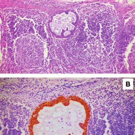 Benign Epithelial Inclusion In A Pelvic Lymph Node Located In The