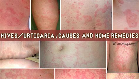 Hives Urticaria Skin Rash Treatment