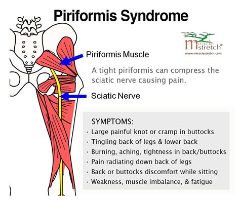 Lower back pain is common, but doing strengthening exercises can relieve symptoms. Learn the Symptoms of Piriformis Syndrome. Get relief with ...