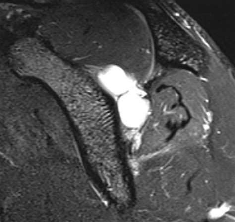Paralabral Cysts Of The Shoulder Treated With Isolated Labral Repair