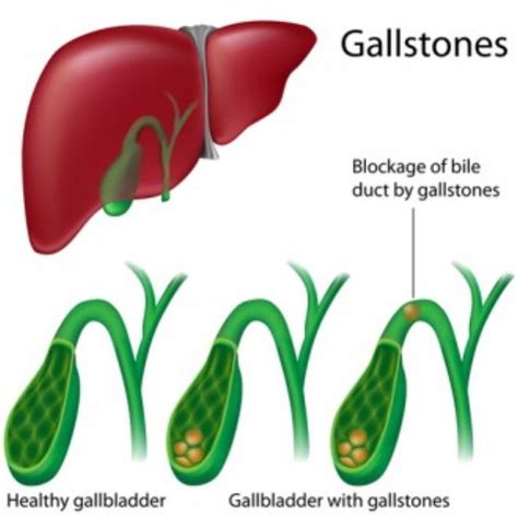 Gallstones Symptoms And Natural Remedies — Health And Wellness —