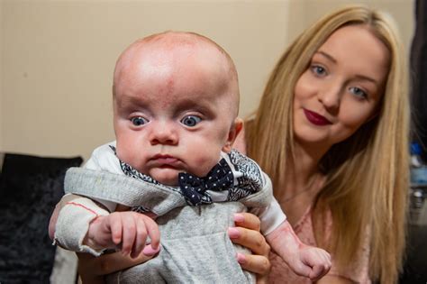 Baby Born Without Skin Defies Doctors Odds To Survive