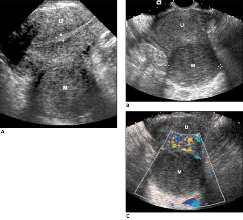 24 Multiple Uterine Fibroids Ultrasound