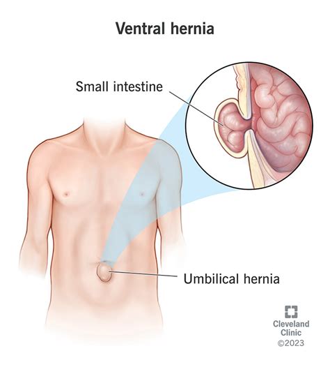 Ventral Hernia What It Is Symptoms Types Treatment And Repair
