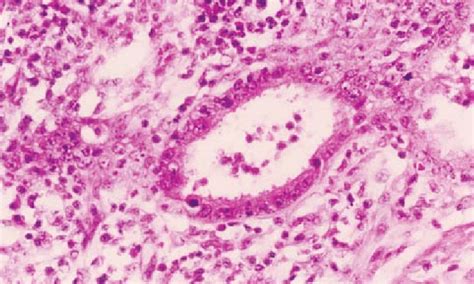 Cryptosporidiosis (often called crypto) is a diarrheal disease caused by a protozoan called cryptosporidium parvum. Cryptosporidiosis Causes, Symptoms, Diagnosis, Treatment ...