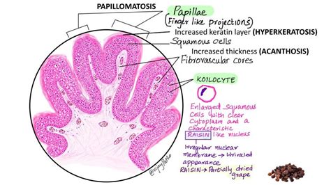 Squamous Papilloma