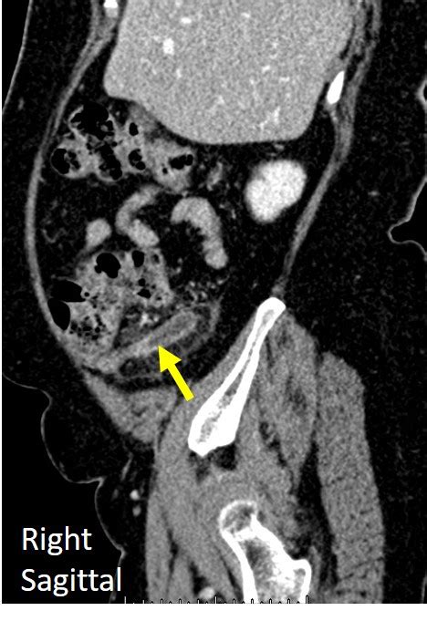 Acute Appendicitis Transverse Retrocaecal Appendix Radiology Cases