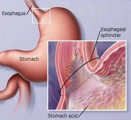 Pedih ulu hati atau heartburn adalah sangat menyakitkan. MyPalace: Pedih Ulu Hati Ketika Hamil