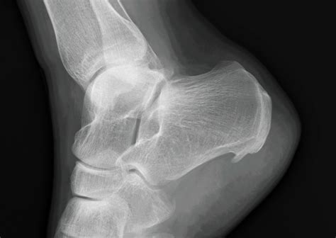 Leaders In Treating Heel Spurs Advanced Ankle And Foot
