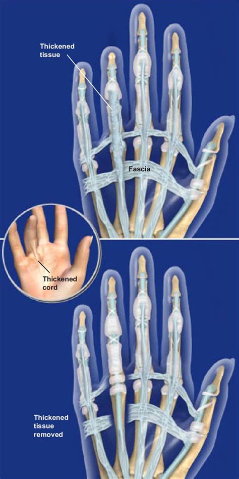 Limited Palmar Fasciectomy For Dupuytrens Contracture