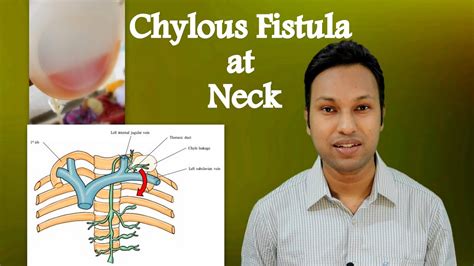 Chylous Fistula At Neck Peroperative And Postoperative Identification
