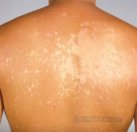 White Skin Spots On Skin Lifecell Cream