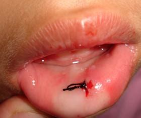In most cases, cysts are caused by an infection or after tooth extraction or a surgical procedure. Tips and Tricks to Effective Parenting: Bump on the Lip