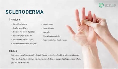 Scleroderma Signs And Symptoms Types Causes And Treatment