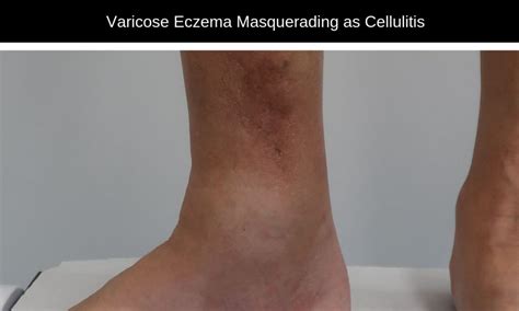 Cellulitis Varicose Eczema Which Is It The Veincare