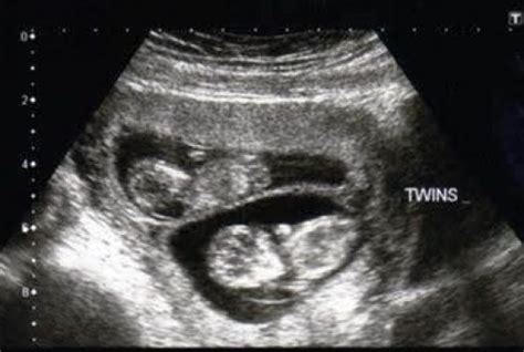 Twin Pregnancy Ultrasound Ultrasoundfeminsider
