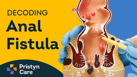 Decoding Fistula Fistula Causes Symptoms And Treatment Options Youtube