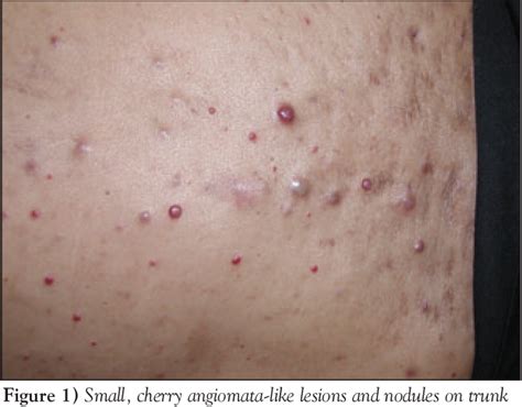 Figure 1 From Bacillary Angiomatosis In An Hiv Positive Man With