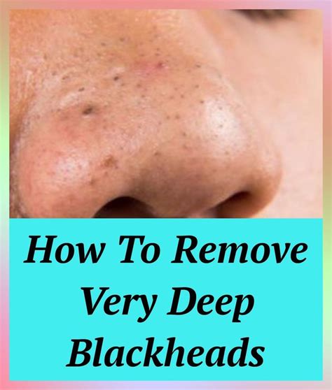How To Remove Very Deep Blackheads In 2020 Deep Blackheads Skin