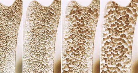 Hip fracture atau patah tulang pinggul adalah kondisi saat tulang di sendi pinggul retak atau patah. Osteoporosis - Penyebab, Gejala, Diagnosis, dan Pencegahan