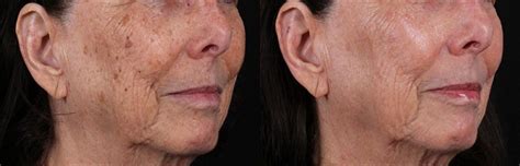 Ipl Photofacial Before And After Images