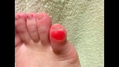 Callus corn blister on little toe of both feet removal at home (part 1