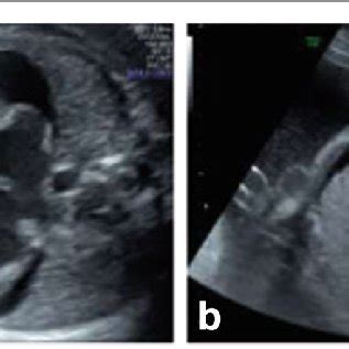 It is caused by fluid buildup in the baby, called hydrops. (PDF) Resolution of maternal Mirror syndrome after ...