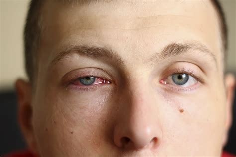 Why Does My Eyes Hurt From Light at Harriet Snow blog