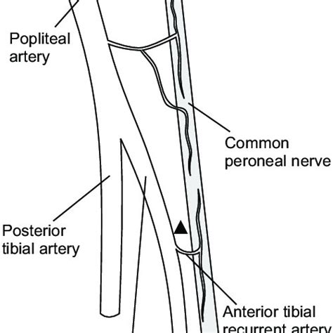 Pdf Common Peroneal Neuropathy With Anterior Tibial Artery Occlusion
