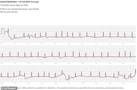 The heart rate is faster than normal, but the heart beats properly. Apple Watch saved life of 46-year-old father whose heart ...
