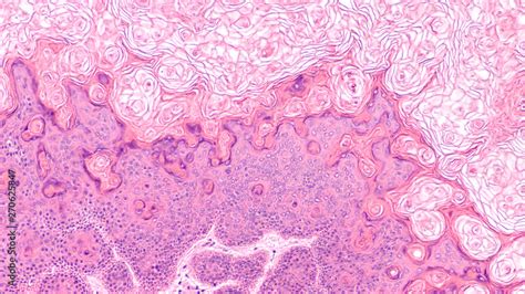 Microscopic Image Of A Proliferating Epidermoid Cyst A Type Of