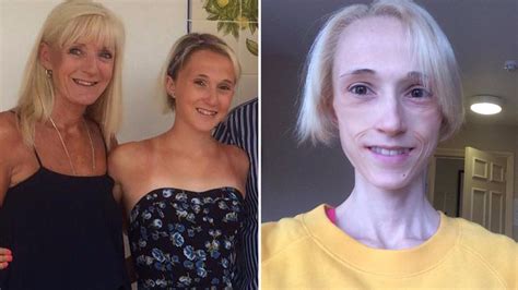 Babe S Shocking Photos Highlight Anorexia Battle That Left Her Weighing Less Than Five Stone