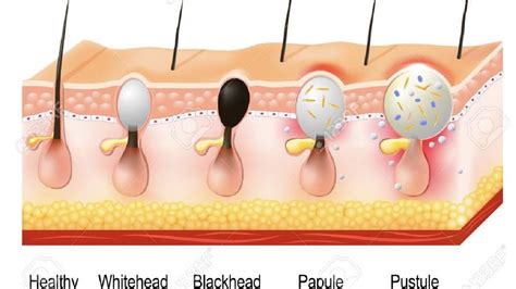 Check spelling or type a new query. why do my blackheads smell like cheese - YouTube