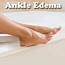 Ankle Edema